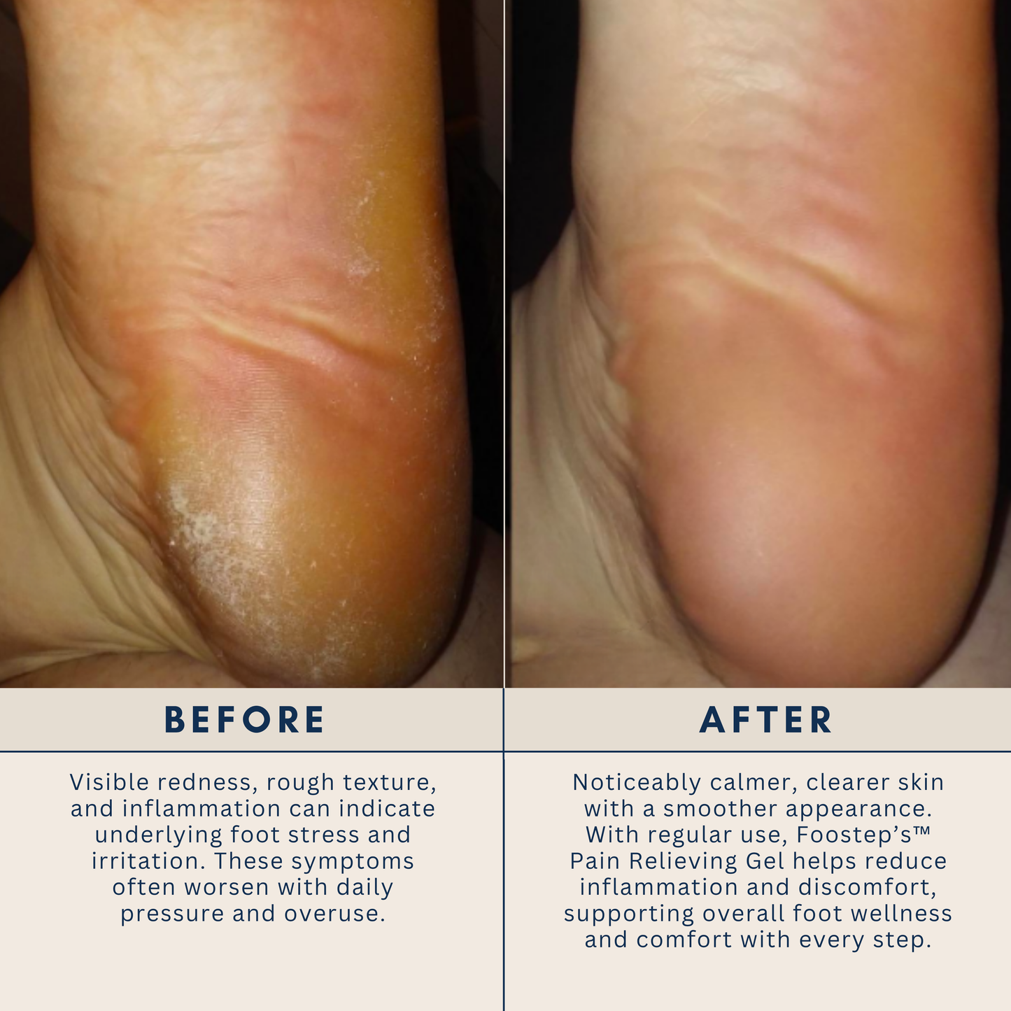 Foostep™ NeuroCool Foot Pain Relief Gel