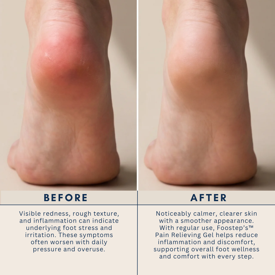 Foostep™ Neuropathy Relief Cream