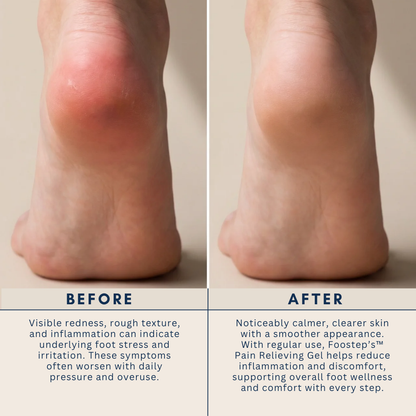 Foostep™ Neuropathy Relief Cream